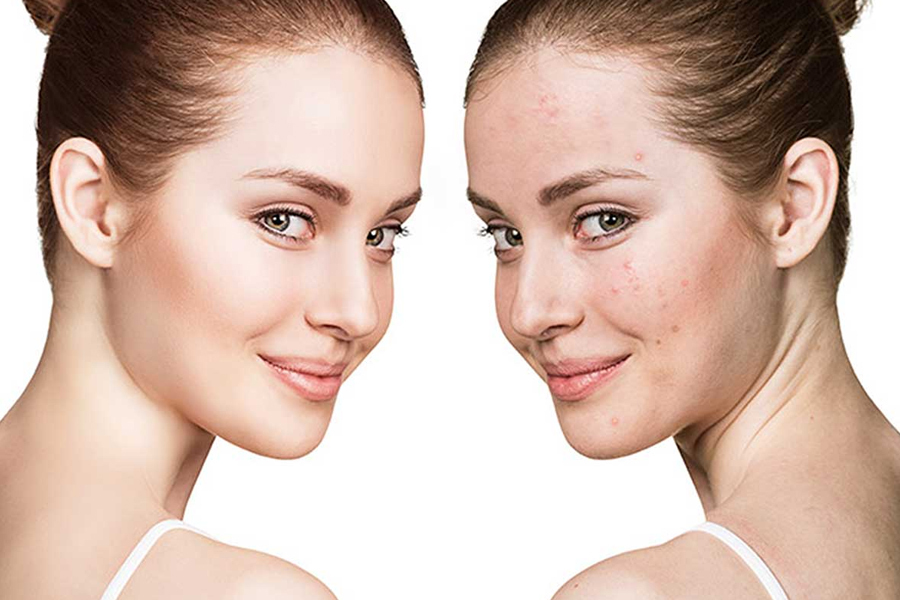 Dùng kem Pond bị nổi mụn nên làm gì?