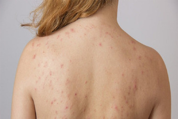 Tắm lá gì trị mụn lưng tốt?
